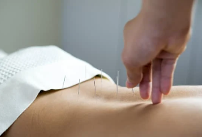 Restore Life Physiotherapy and Wellness employee providing Acupuncture in waterloo and client is happy and smiling