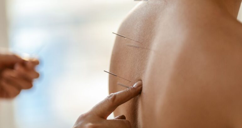 Discover the Healing Power of Acupuncture Therapy in Waterloo